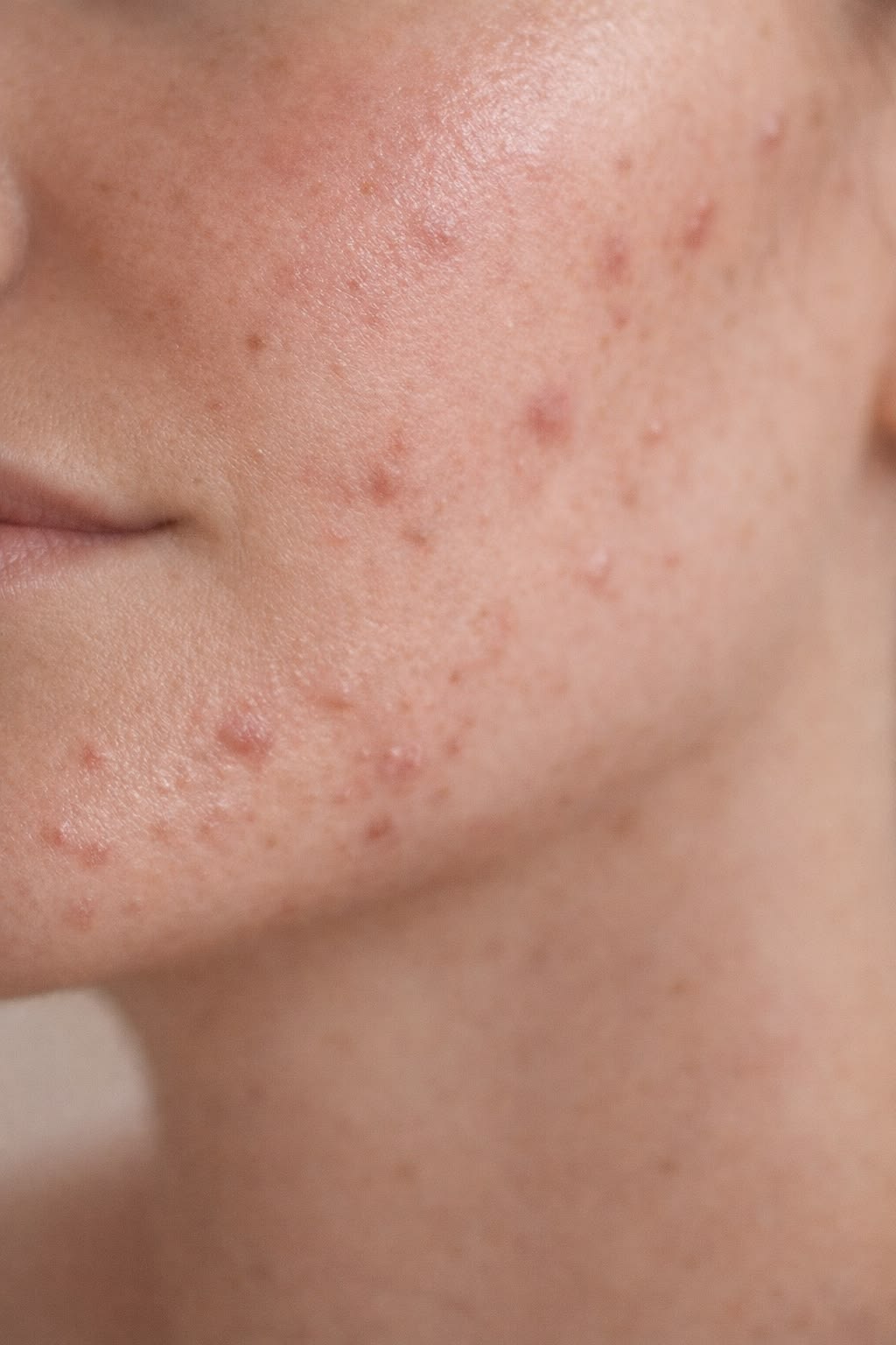 Acne, Acne Marks & Scarring