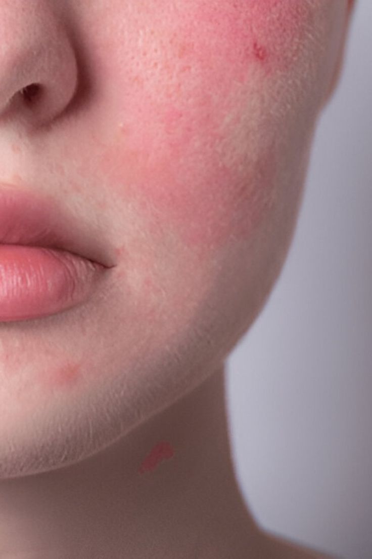 Sensitivity & Redness